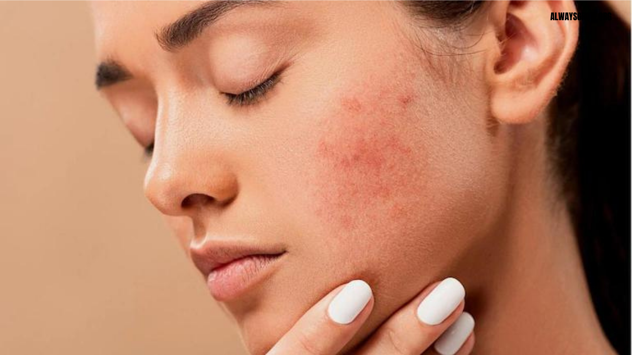 how-to-get-rid-of-red-spots-on-face-quickly-9-tips